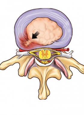 Bulging Discs Healing - 3 Tips - How To Heal Disc NATURALLY Bulging Discs Healing - 3 Tips - How To Heal Disc NATURALLY