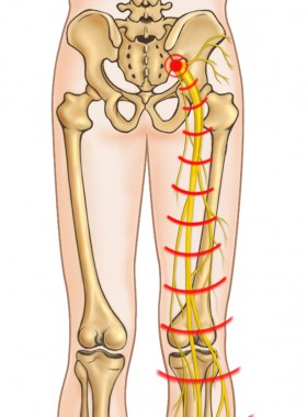 Sciatica - Best Way To Treat Sciatic Pains Sciatica - Best Way To Treat Sciatic Pains