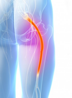 Sciatic Nerve Pain Sciatic Nerve Pain