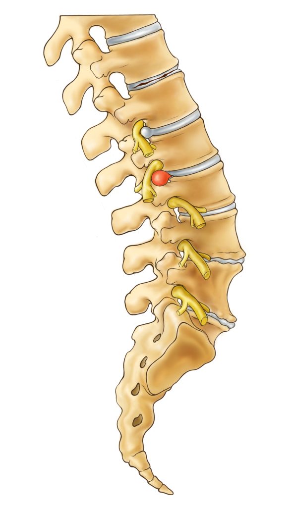 Bulged Disc