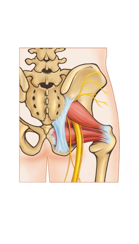 Piriformis muscle entrapment