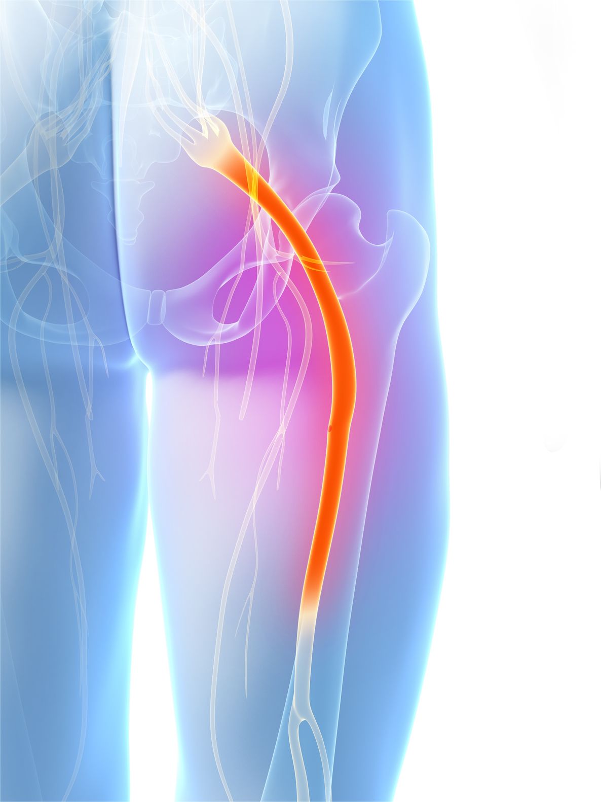 Sciatic nerve pain