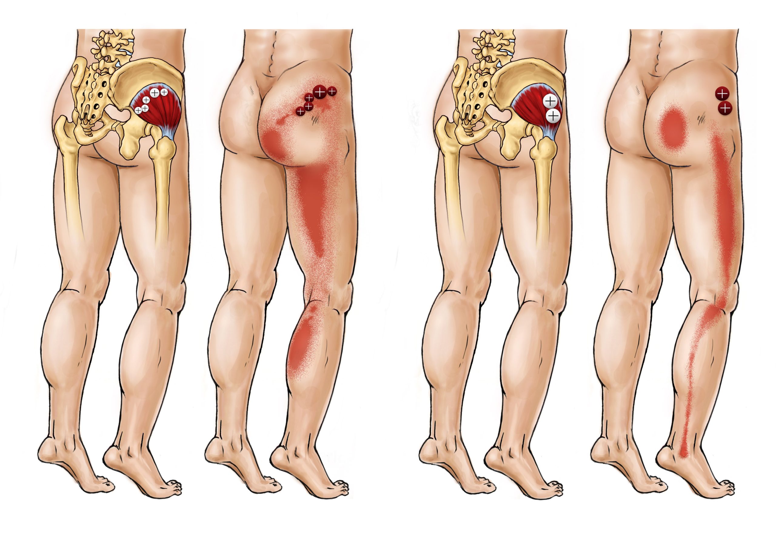 Sciatic triggerpoints