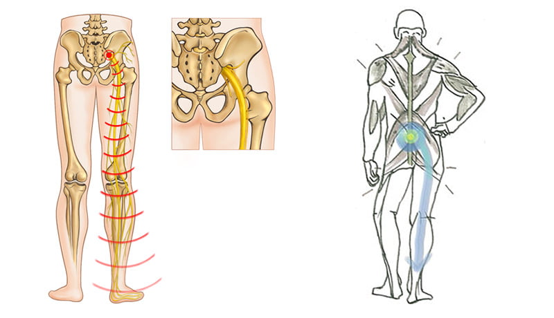 Sciatica Sciatic Nerve